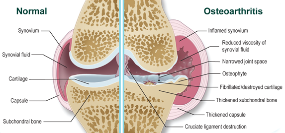 Csípő osteoarthritis betegség